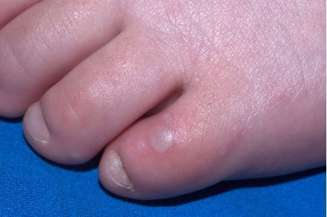 Image to show blisters on the toes