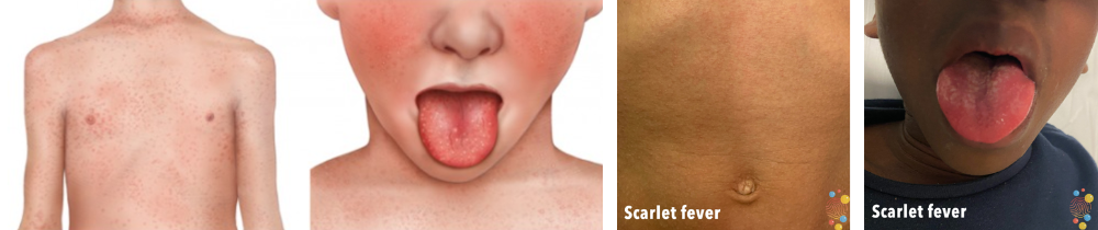 Group A Streptococcus and Scarlet Fever :: Hertfordshire and West Essex  Healthier Together