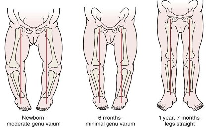 Knock knees - NHS