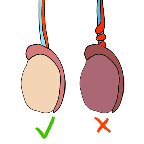 testicular-torsion-painful-poster.png
