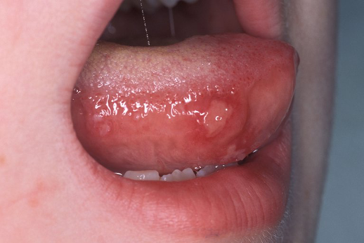 Image to show ulcers on the tongue