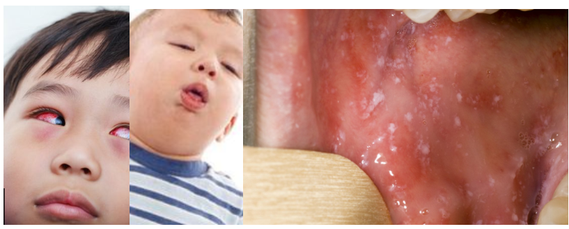 Pictures of children with symptoms of conjunctivitis, cough and spots in the mouth