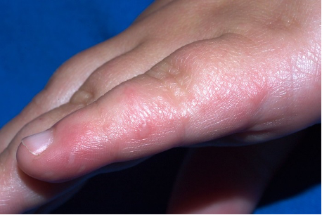 Image to show blisters on the fingers