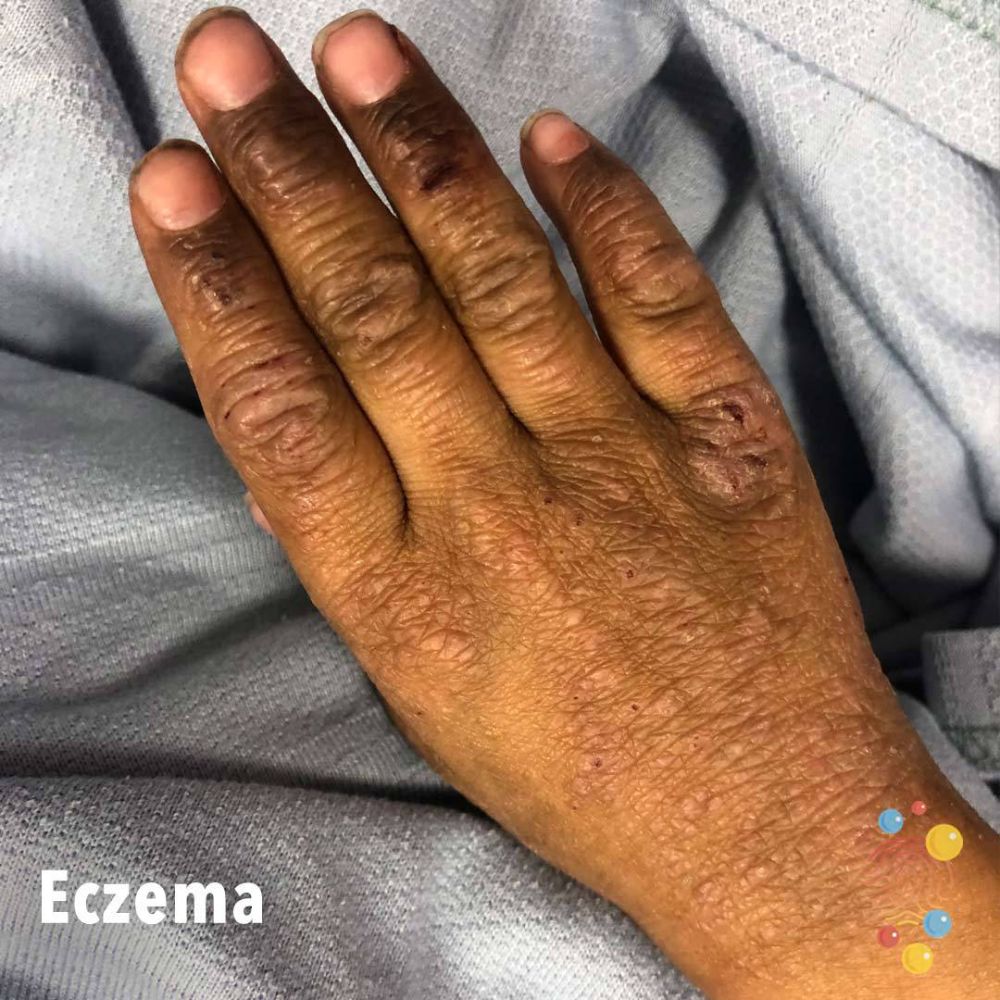 Eczema_image_on_dark_skin.jpg